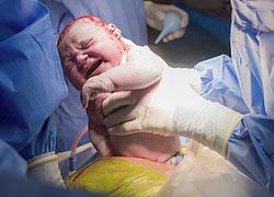 Τι είναι η «φυσιολογική» καισαρική και γιατί βοηθάει το μωρό;
