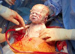 Ένα συγκλονιστικό βίντεο: Μητέρα μαγνητοσκοπεί την καισαρική της