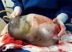 Ένα συγκλονιστικό βίντεο: Μωρό γεννιέται μέσα στον αμνιακό του σάκο
