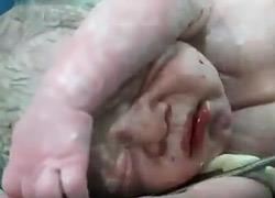 Ένα συγκλονιστικό βίντεο: Γιατροί επαναφέρουν στη ζωή ένα νεογέννητο μωρό