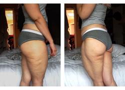 «Το Σάββατο της κυτταρίτιδας»: Το «κίνημα» που θα σας πείσει να αγαπήσετε το σώμα σας