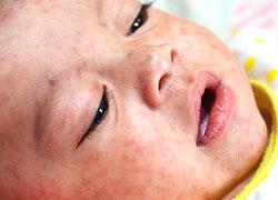 Έξαρση της ιλαράς στις χώρες της Ευρώπης που έχουν μειώσει τον εμβολιασμό