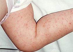 Μηνιγγίτιδα: Μία ύπουλη και σοβαρή νόσος που απαιτεί την προσοχή σας