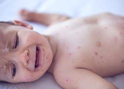 Βρέφος 11 μηνών έχασε τη ζωή του από ιλαρά 