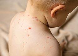 Ιλαρά: Τρίτη στην Ευρώπη η χώρα μας σε κρούσματα 