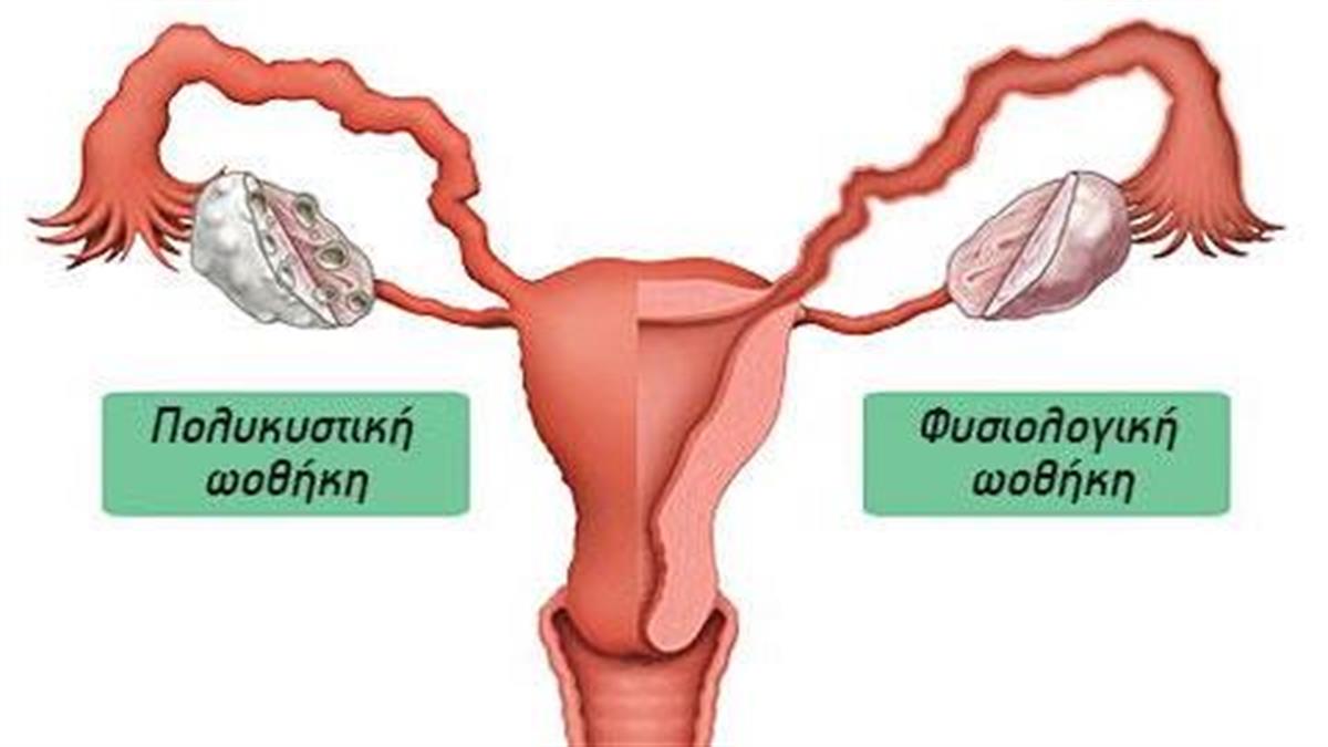 Σύνδρομο Πολυκυστικών Ωοθηκών και επιθυμία σύλληψης