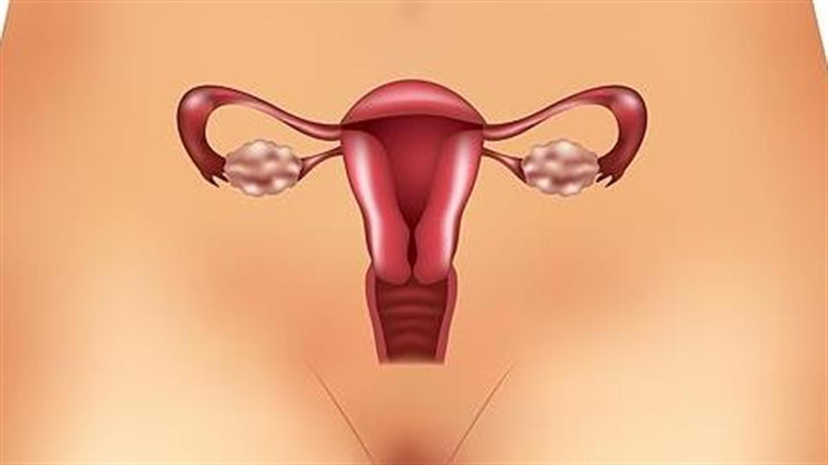 Πολυκυστικές ωοθήκες: Συμπτώματα & θεραπεία