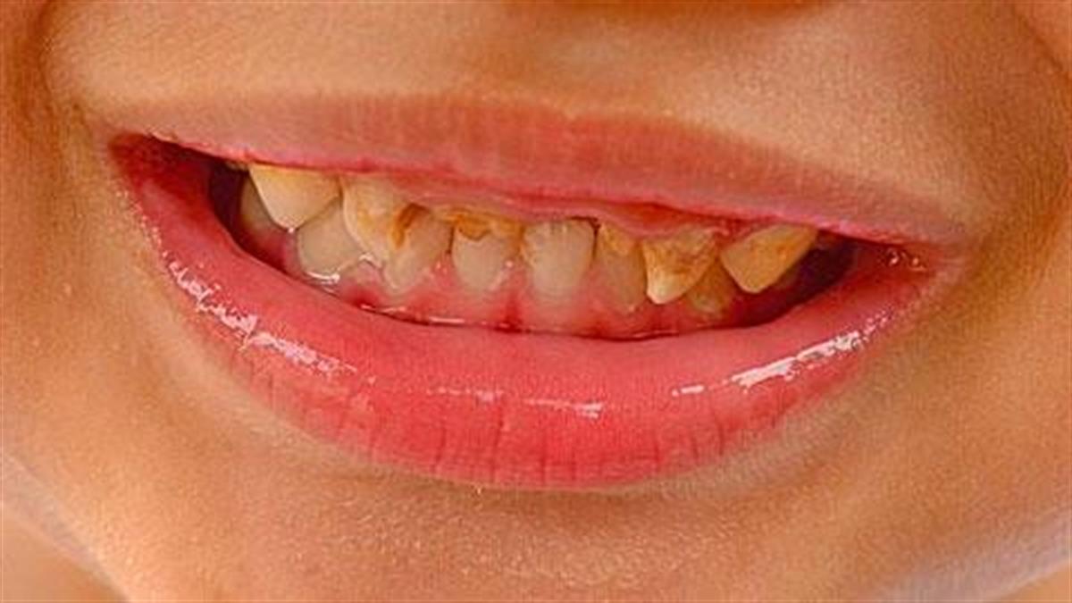 Ποια είναι η νούμερο 1 τροφή που χαλάει τα δόντια των παιδιών;