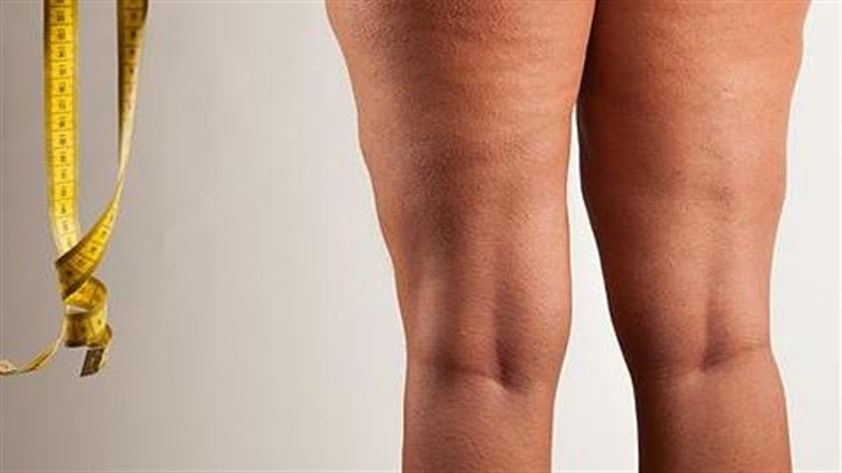 Τα 5 μεγαλύτερα προβλήματα μιας γυναίκας με χοντρά πόδια