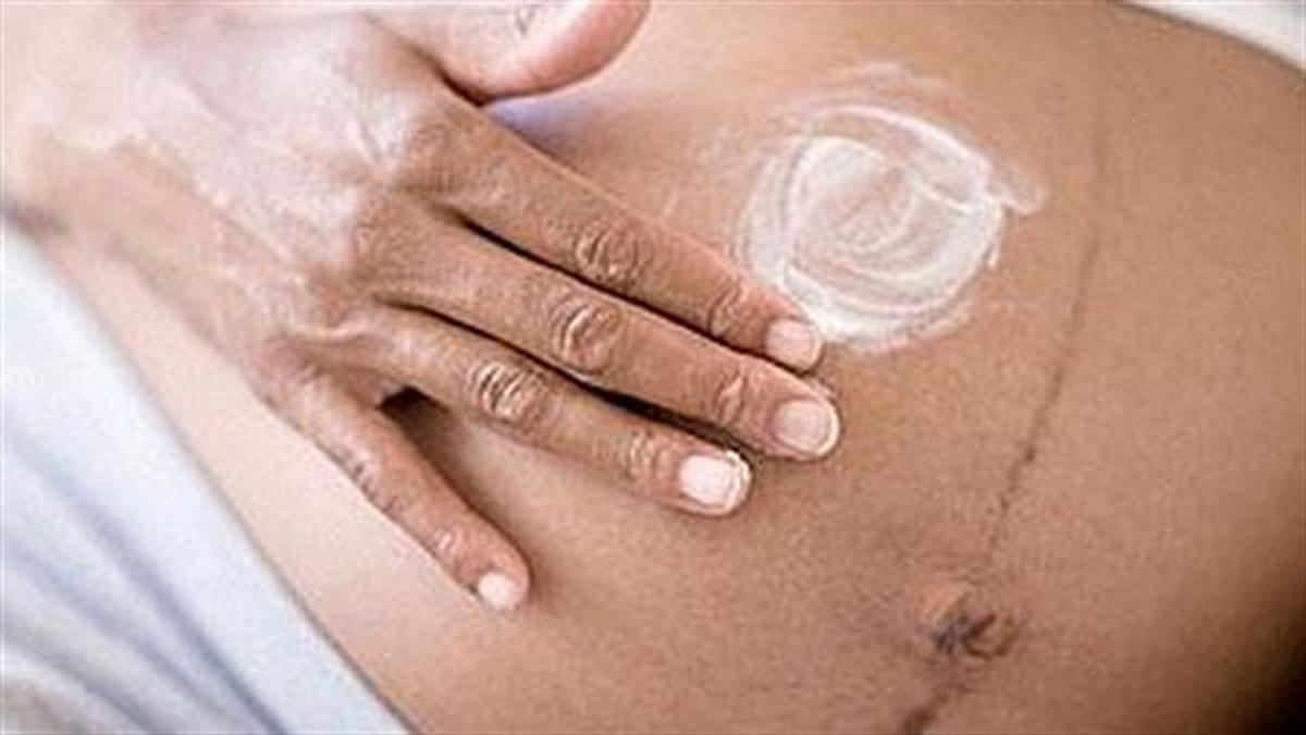 Ποιο προϊόν να χρησιμοποιήσω για να μην κάνω ραγάδες στην εγκυμοσύνη;