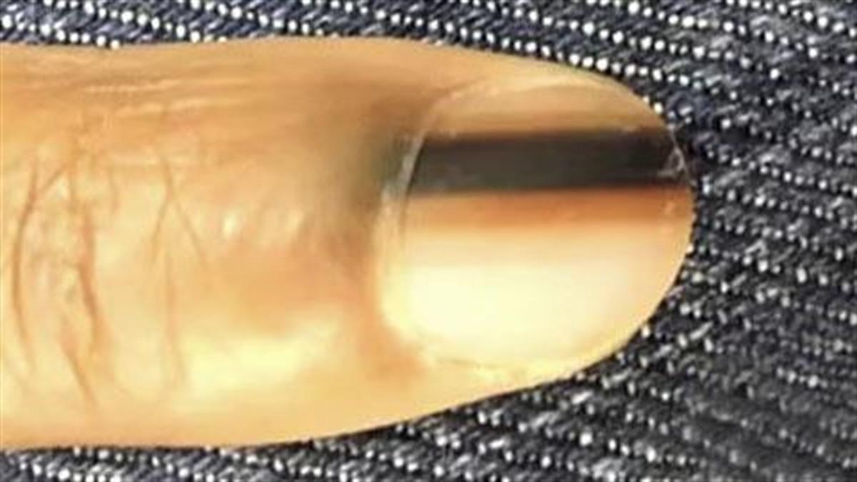 Μάθετε πώς τα σημάδια στα νύχια μπορεί να φανερώνουν καρκίνο του δέρματος