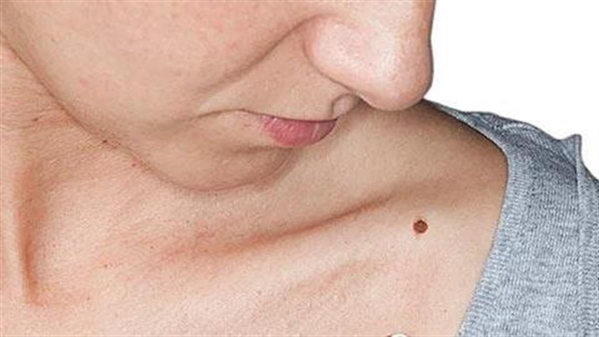 Όλα όσα πρέπει να γνωρίζετε για τις ελιές στο δέρμα σας