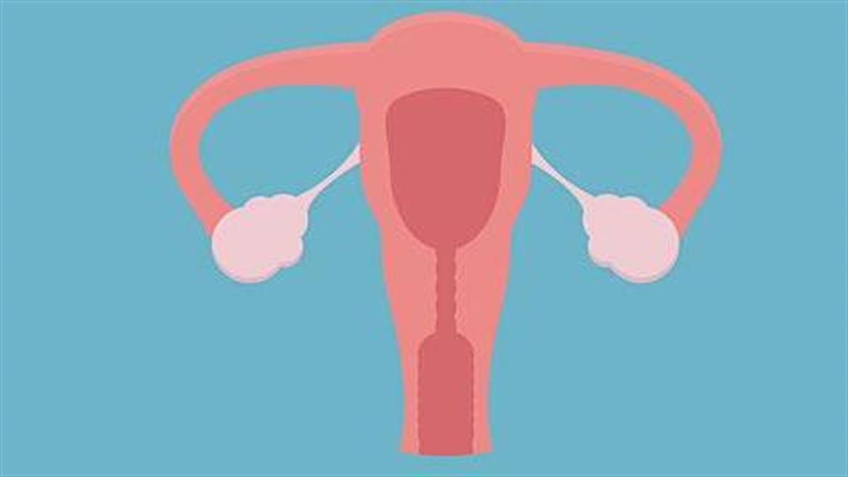 Μπορούν οι πολυκυστικές ωοθήκες να εμποδίσουν ενδεχόμενη εγκυμοσύνη;