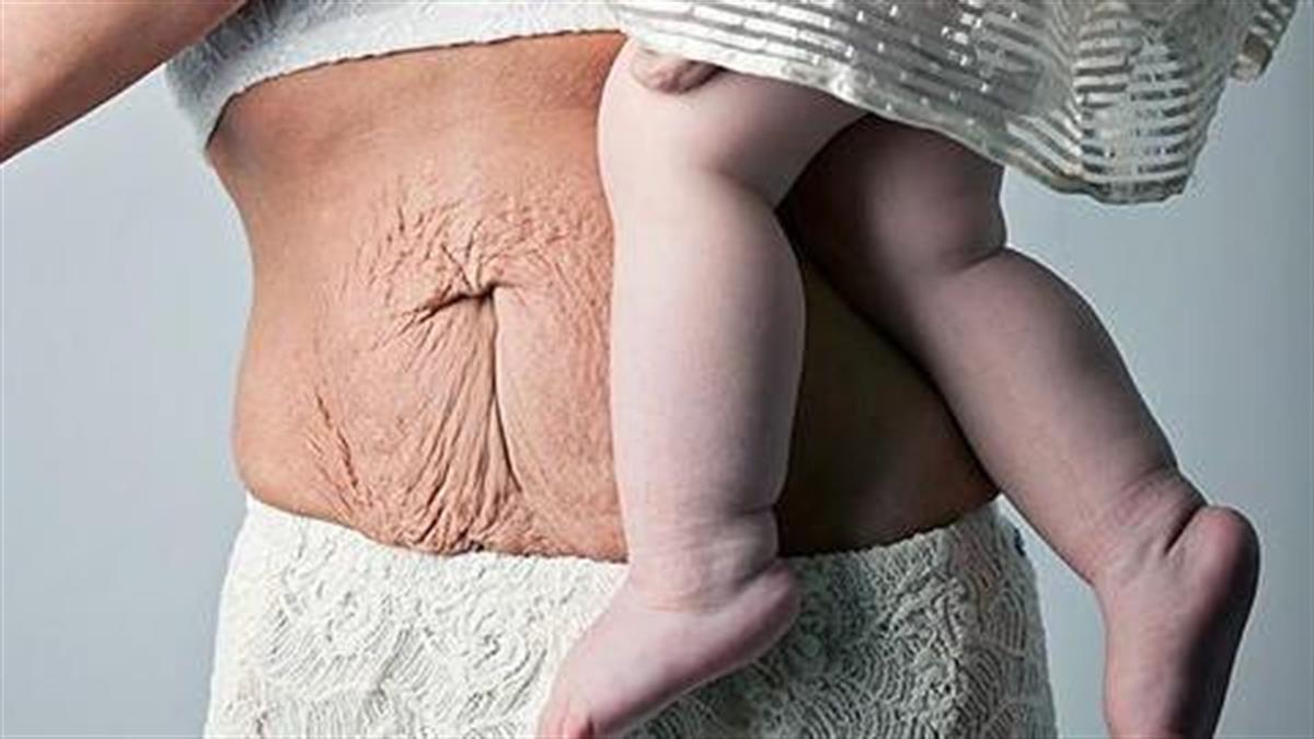 12 γυναίκες δείχνουν πώς πραγματικά είναι το σώμα τους μετά την εγκυμοσύνη