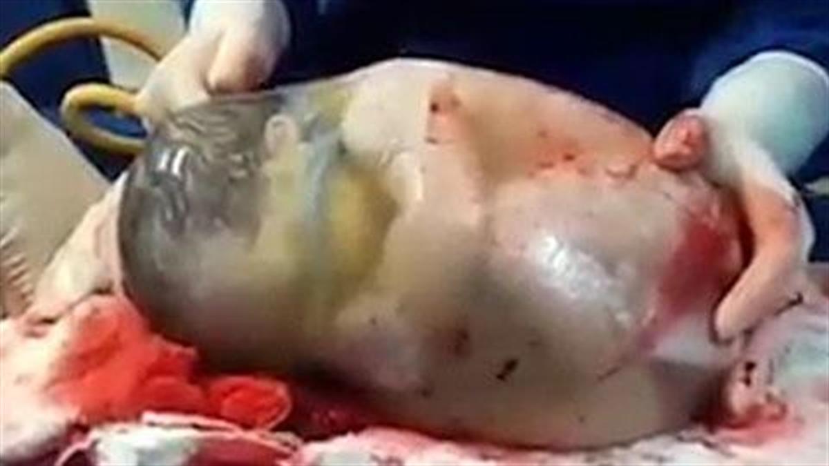Ένα συγκλονιστικό βίντεο: Μωρό γεννιέται στον αμνιακό σάκο