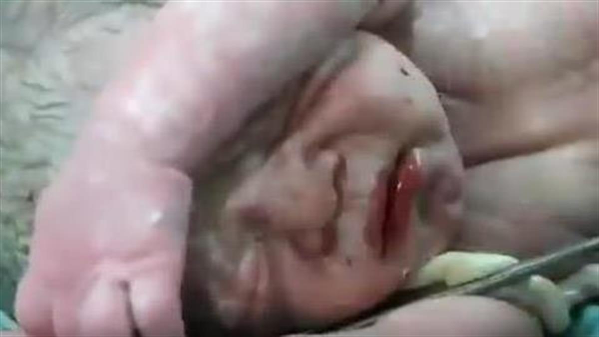 Συγκλονιστικό βίντεο: Γιατροί επαναφέρουν στη ζωή μωρό μετά από μια δύσκολη καισαρική