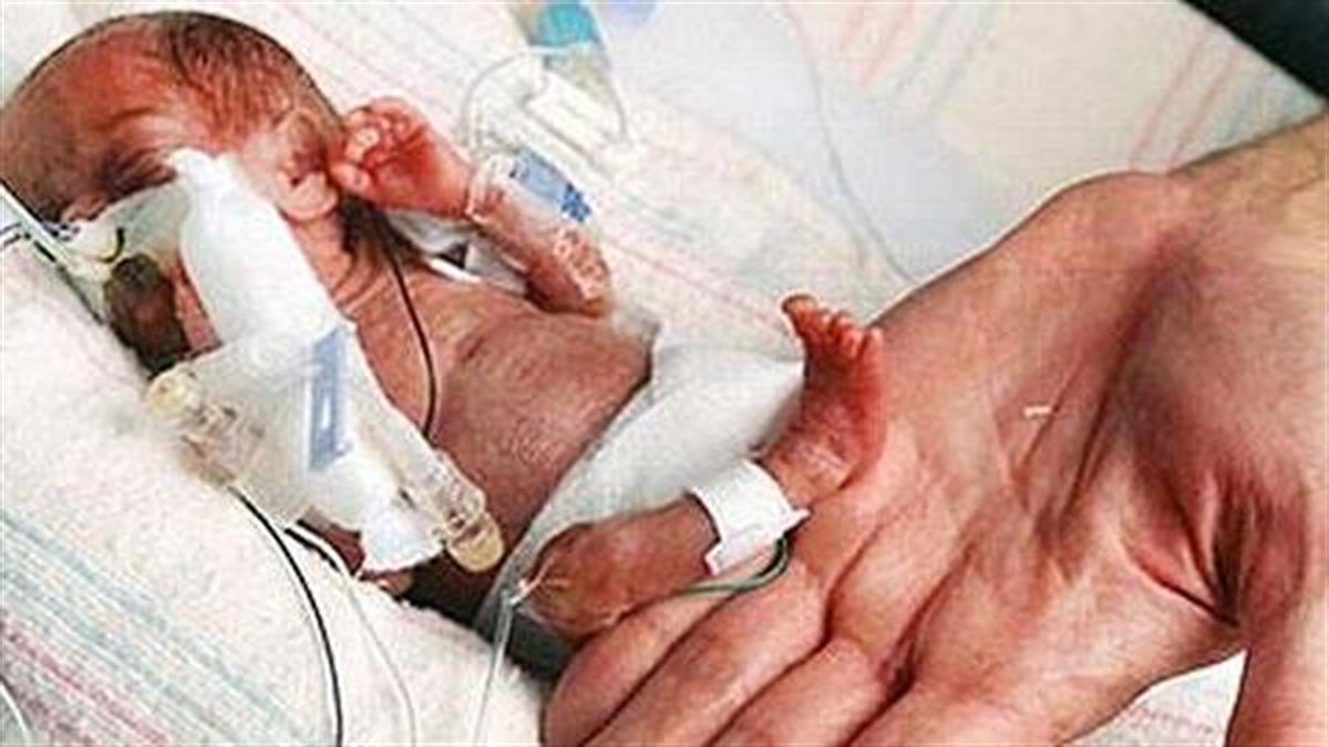Το μικρότερο νεογέννητο στον κόσμο που κατάφερε να επιζήσει!