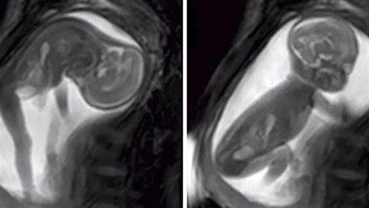 Νέα μέθοδος λεπτομερούς απεικόνισης του εμβρύου μέσω... βίντεο!