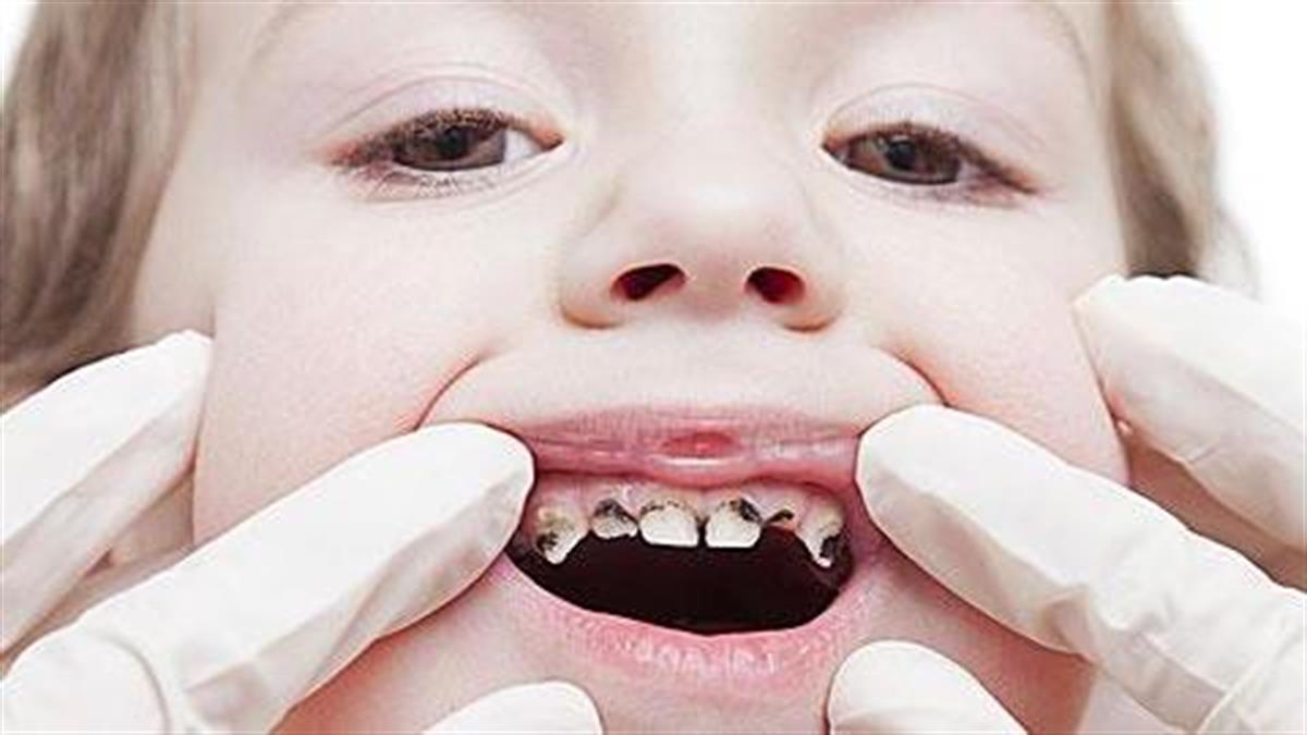 Ποιες τροφές καταστρέφουν τα δόντια των παιδιών