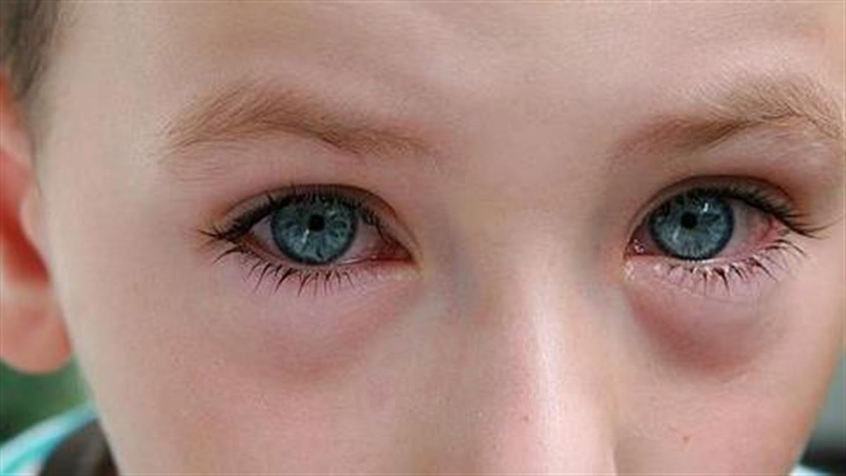 Ερεθισμένα παιδικά μάτια: Να ανησυχήσετε ή όχι