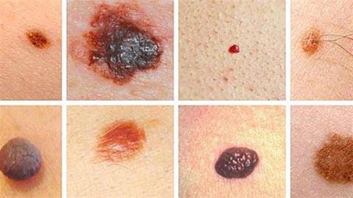 Καρκίνος του δέρματος: Τα χαρακτηριστικά που πρέπει να σας ανησυχήσουν