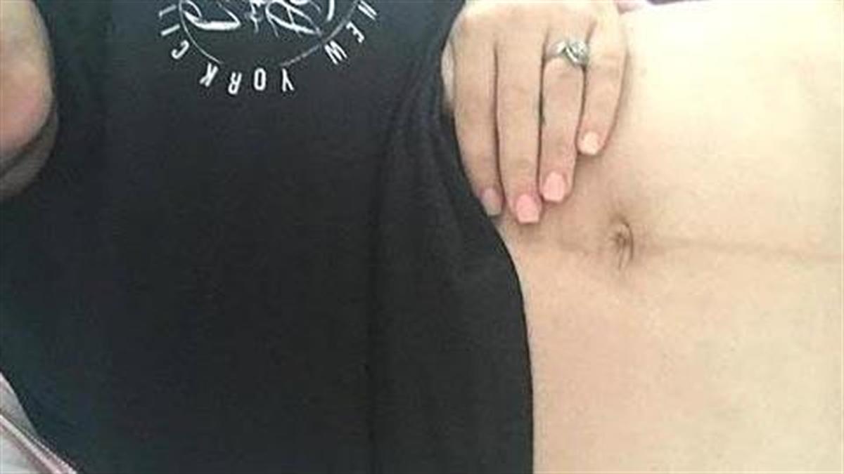 Πώς είναι το σώμα μιας γυναίκας 4 μέρες μετά την καισαρική