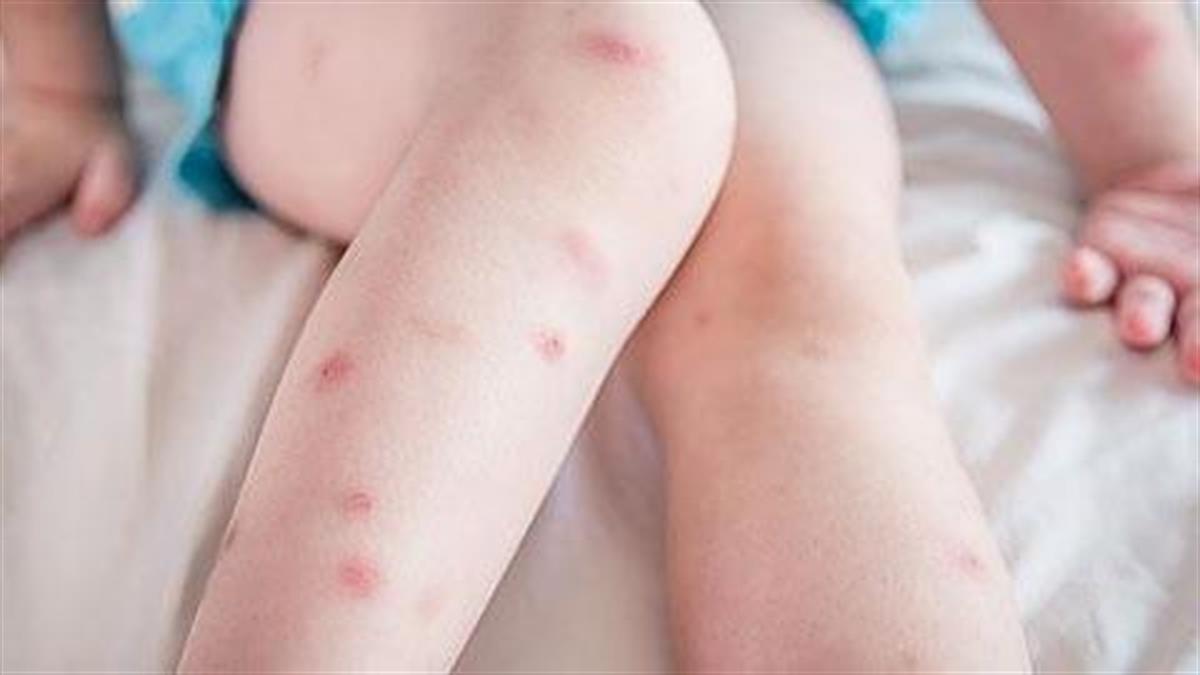 Πώς να κρατήσετε τα κουνούπια μακριά από τα παιδιά