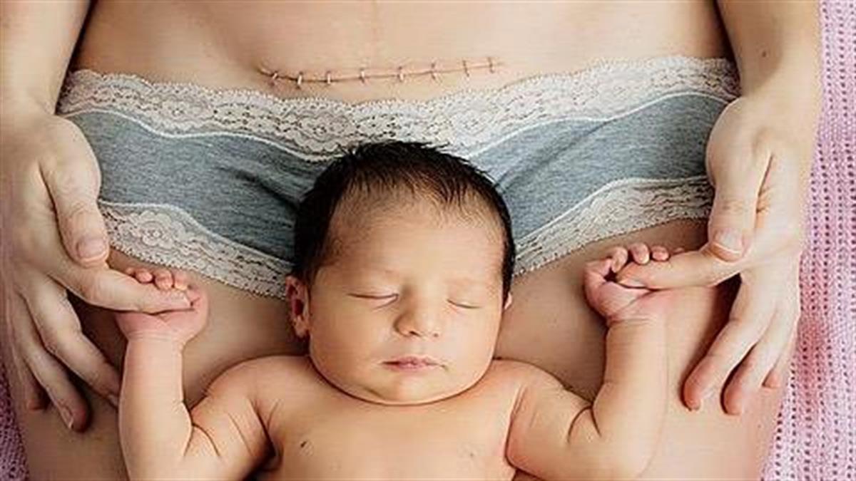 7 αλήθειες που θα καταλάβουν μόνο οι γυναίκες που γέννησαν με καισαρική