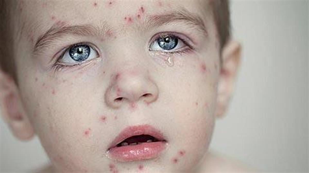 Ελληνική Παιδιατρική Εταιρεία: Τι πρέπει να ξέρει κάθε γονιός για την έξαρση της ιλαράς
