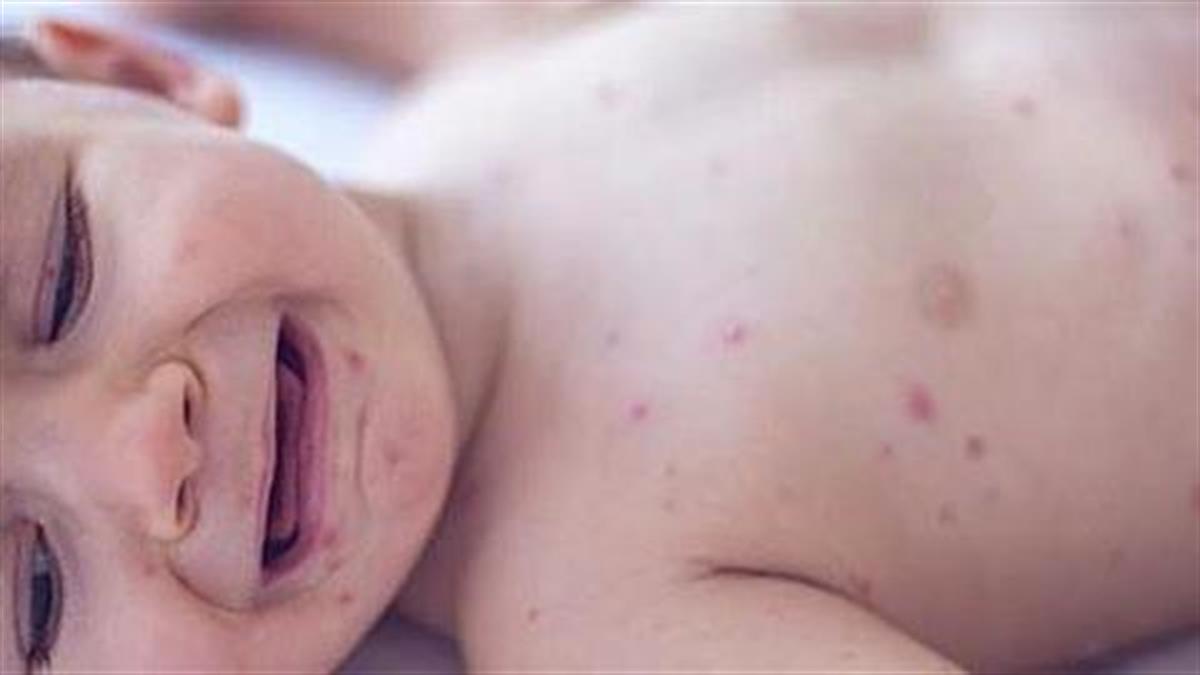 Βρέφος 11 μηνών το πρώτο θύμα της ιλαράς στην Ελλάδα