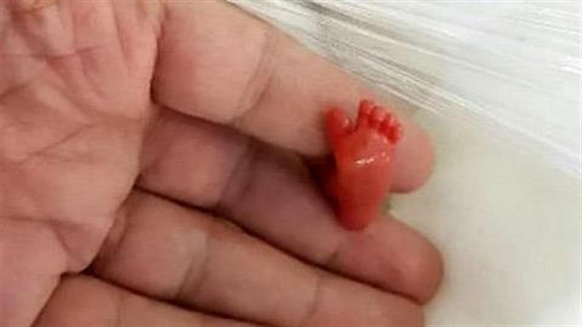 Ένας πραγματικός μαχητής: Αυτό το πρόωρο μωράκι ζύγιζε μόλις 400 γραμμάρια αλλά κατάφερε να επιβιώσει!