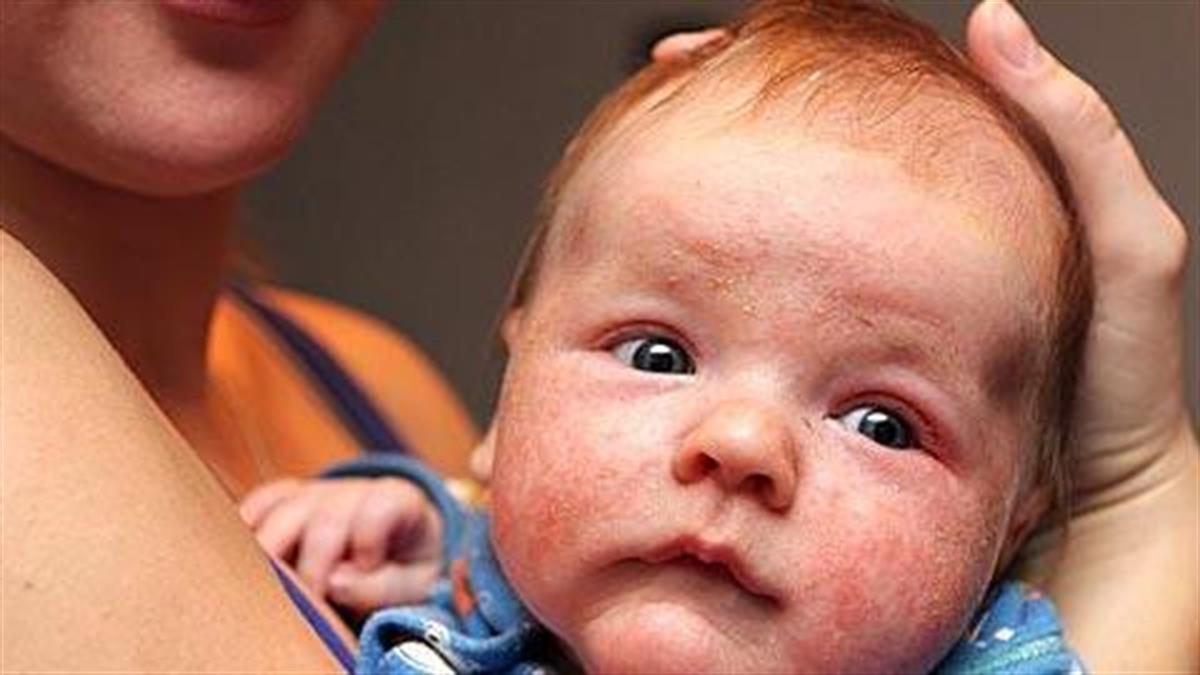 Ατοπική δερματίτιδα: Πώς θα την αναγνωρίσετε και πώς θα ανακουφίσετε το μωρό σας