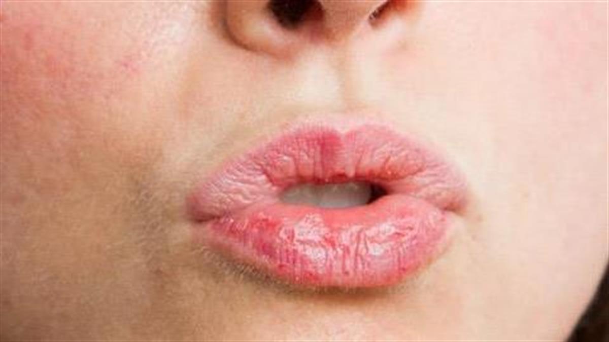 7 τρόποι να απαλλαγείτε από τα σκασμένα χείλη