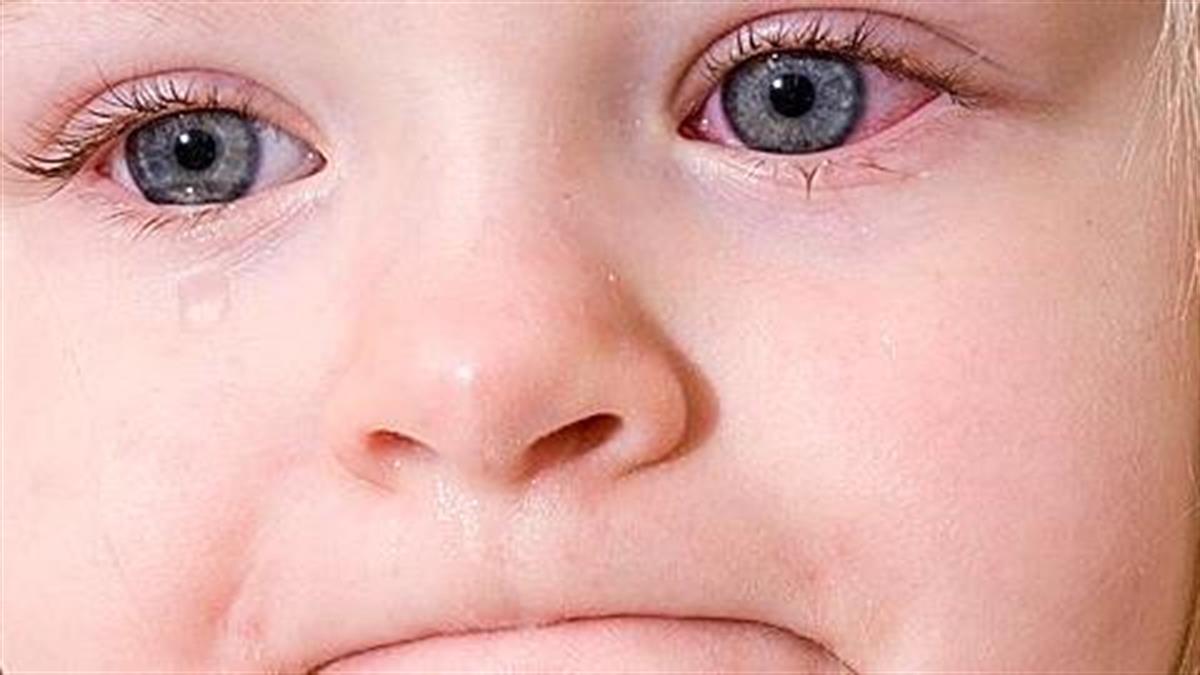 Επιπεφυκίτιδα στα παιδιά: Ποια είναι τα συμπτώματα και πώς αντιμετωπίζεται