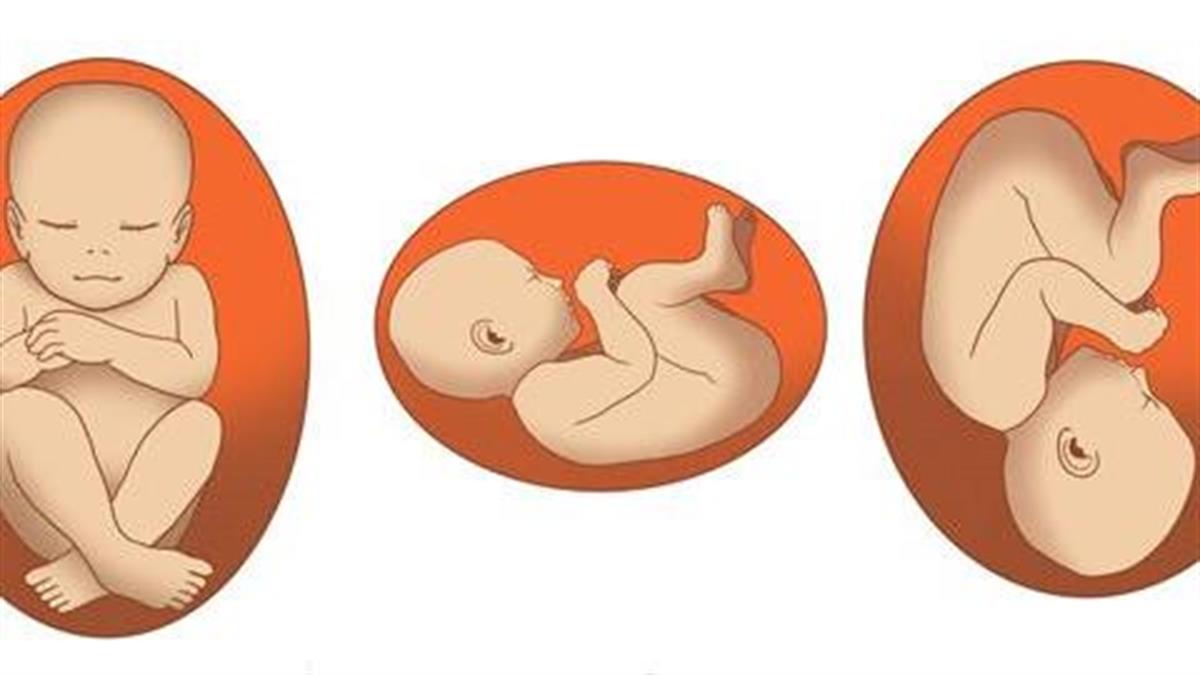 Πώς επηρεάζουν τον τοκετό οι θέσεις που παίρνει το έμβρυο στην εγκυμοσύνη