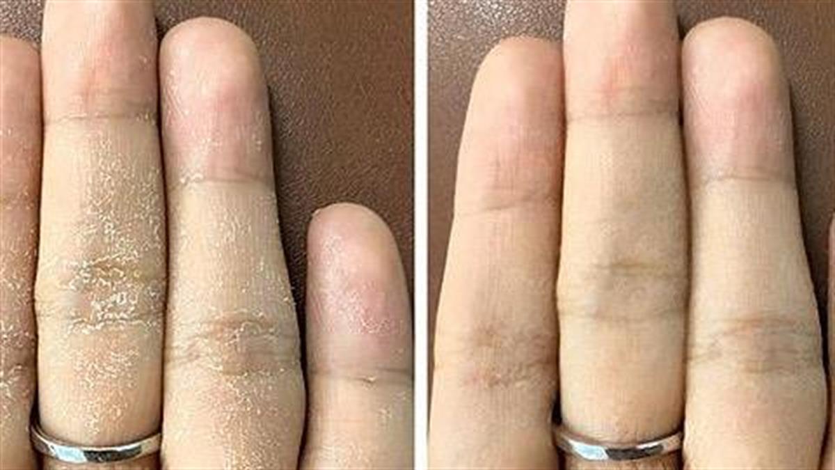5 τρόποι να κρατήσεις τα χέρια σου απαλά παρά τα πλυσίματα και τις χλωρίνες