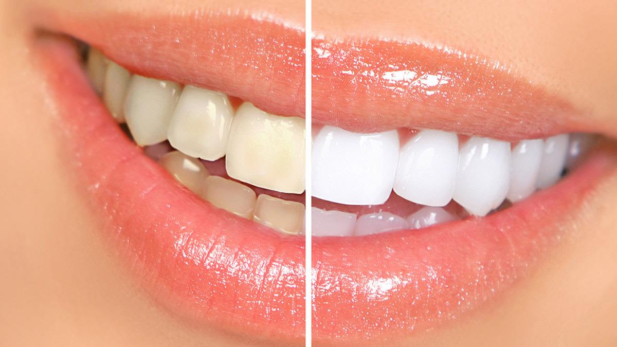 Το πιο λευκό χαμόγελο: μυστικά ομορφιάς για κάτασπρα δόντια