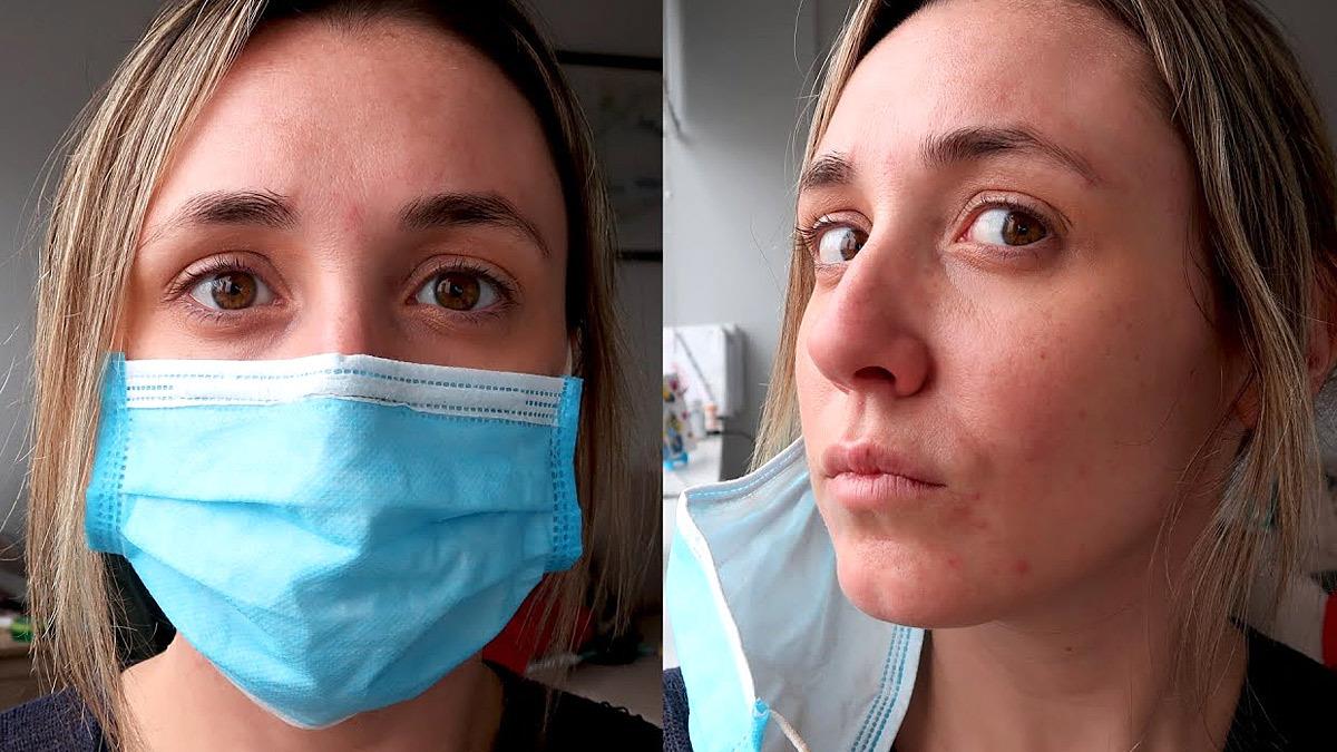 Maskne: η ακμή από την χρήση μάσκας και πώς να την αντιμετωπίσουμε