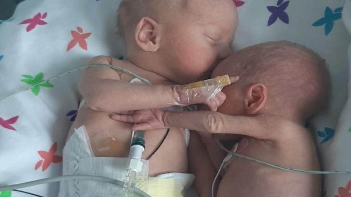 Νεογέννητο κοριτσάκι που έζησε από θαύμα αγκαλιάζει τον δίδυμο αδερφούλη της