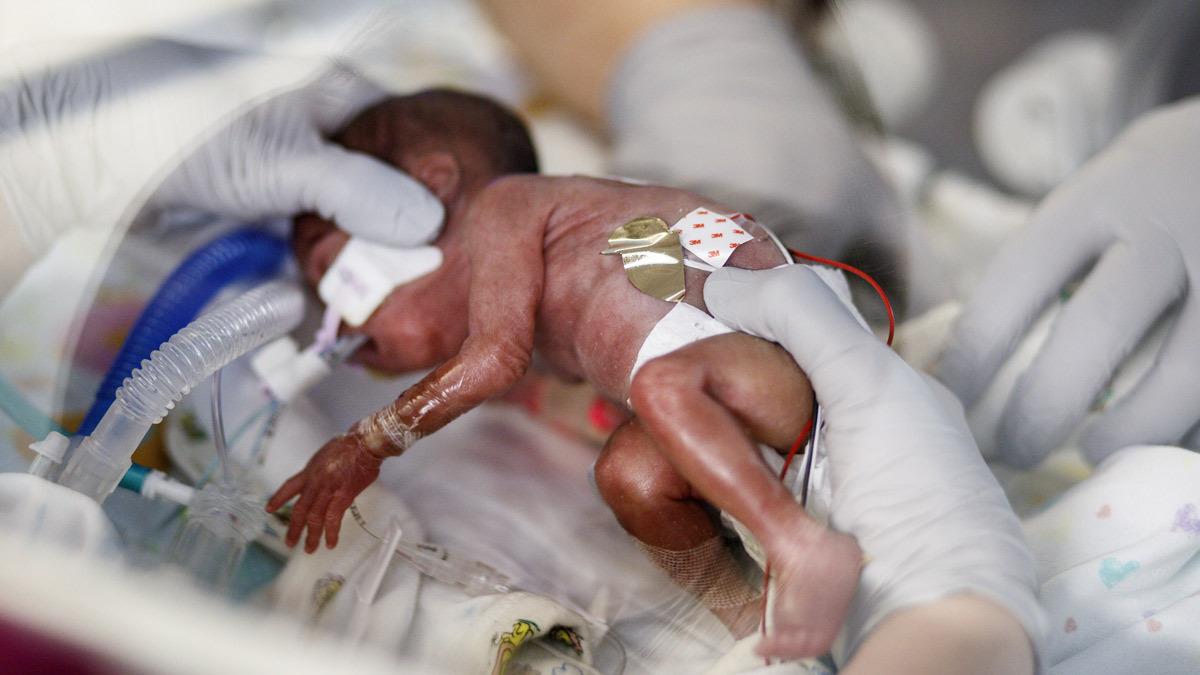 Mωράκι που γεννήθηκε μόλις 250 γραμμάρια κέρδισε τη δύσκολη μάχη και επέζησε