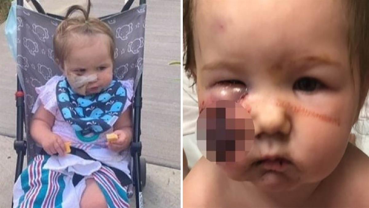 Σκύλος επιτέθηκε σε κοριτσάκι 11 μηνών - έκανε 50 ράμματα στο πρόσωπο