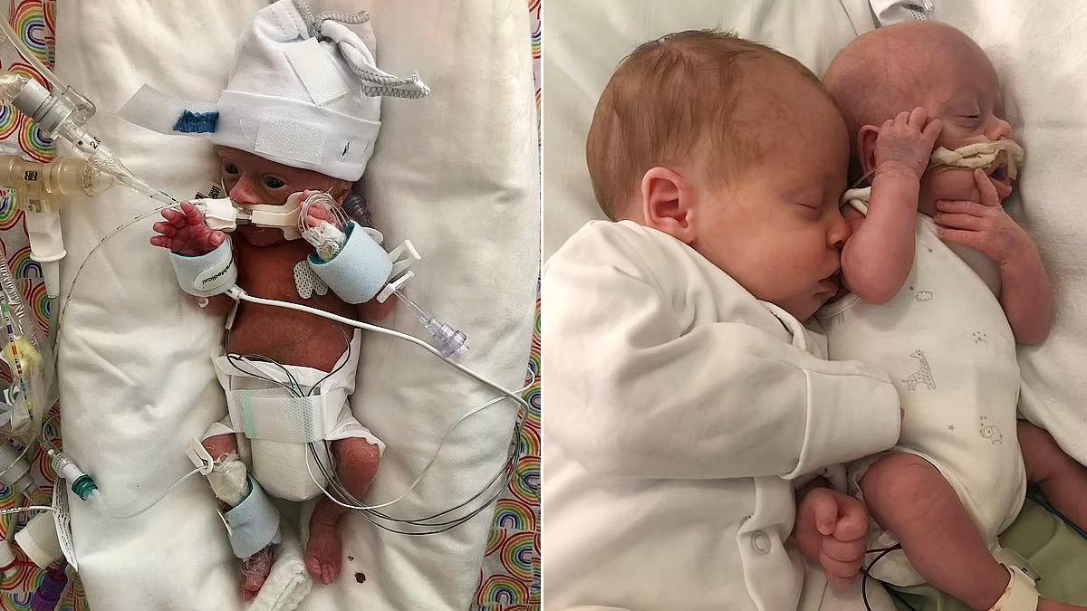 Πρόωρο μωράκι με προβλήματα υγείας παίρνει δύναμη από το δίδυμο αδερφάκι του