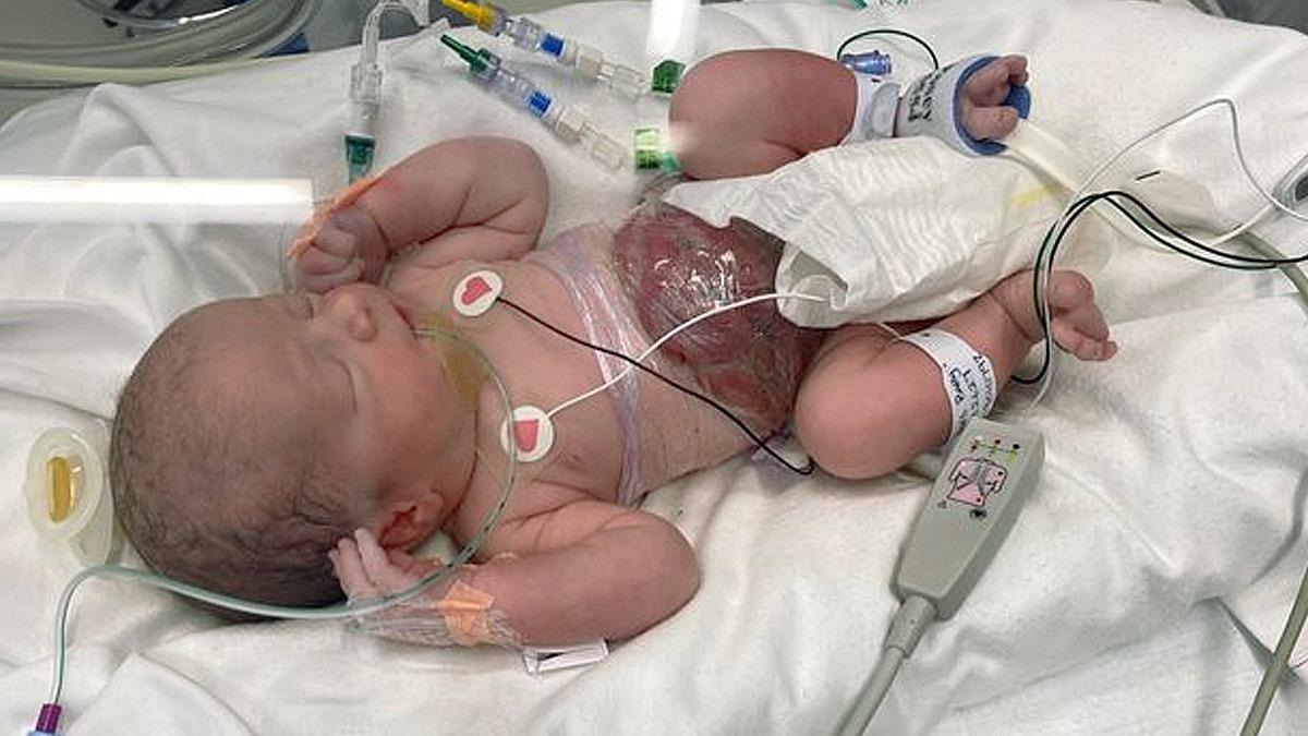 Μωρό γεννήθηκε με ζωτικά όργανα έξω απ το σώμα του, αλλά επιβίωσε και είναι καλά