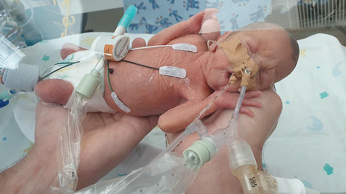 Πρόωρο μωρό διέψευσε τους γιατρούς που έλεγαν ότι θα γεννηθεί εγκεφαλικά νεκρό