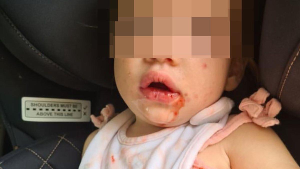 Μην αφήνετε να φιλάνε το μωρό σας - η κόρη μου κόλλησε έρπη και βασανίζεται