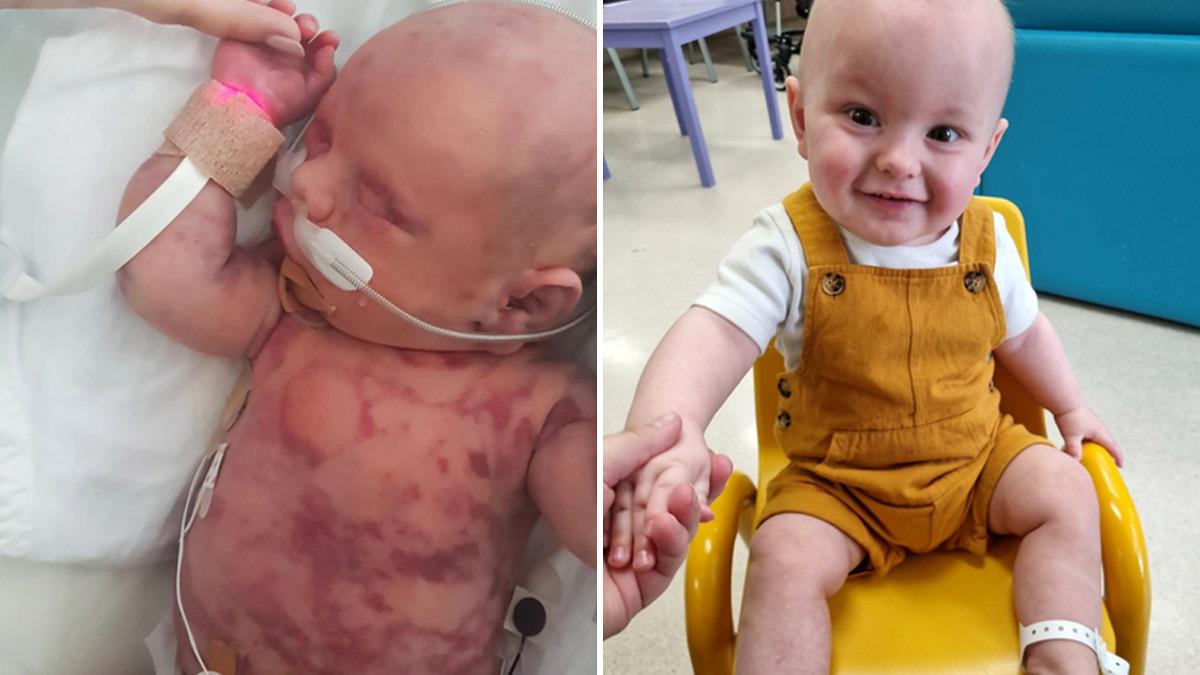 Μωρό-μαχητής που γεννήθηκε με λευχαιμία δεν το βάζει κάτω και χαμογελά