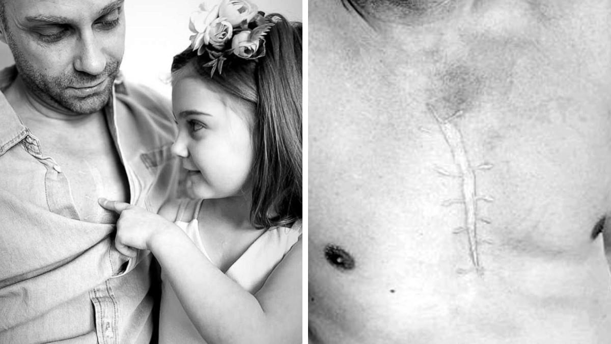 Μπαμπάς έκανε τατουάζ ίδιο με την ουλή της κόρης του για να της συμπαρασταθεί!