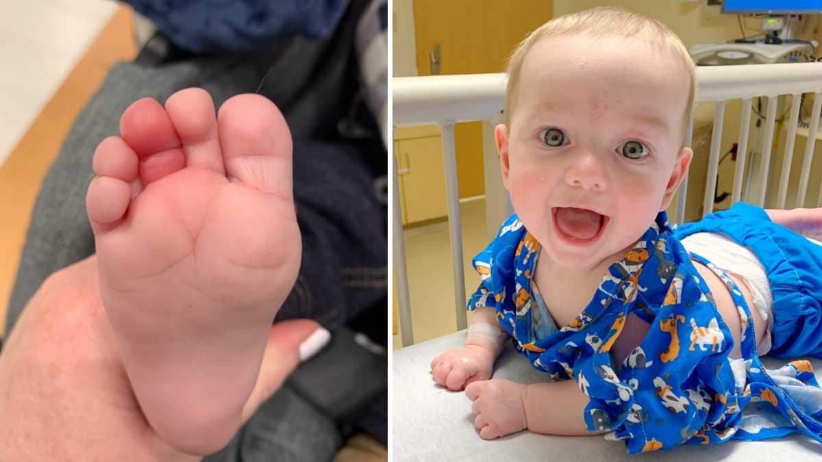 Μωράκι 5 μηνών κόντεψε να χάσει το δάχτυλό του... από μια τρίχα!