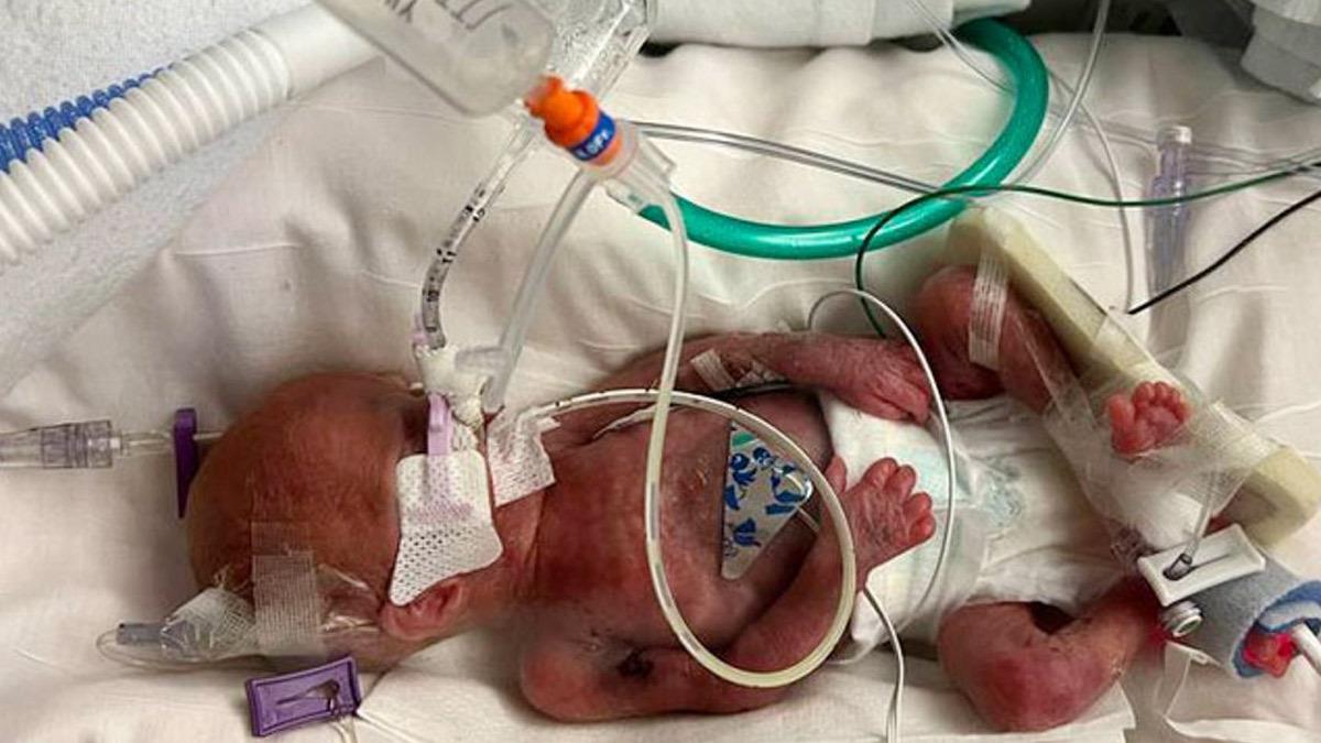 Μωράκι που γεννήθηκε στις 20 εβδομάδες δίνει μάχη για τη ζωή του!