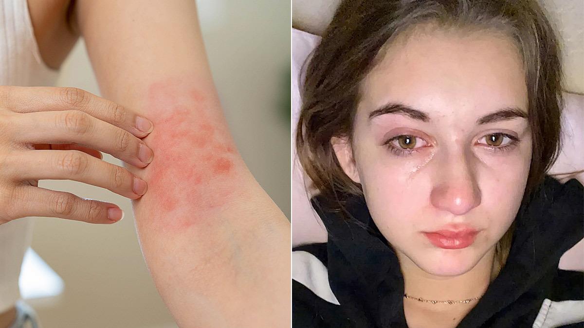 15χρονη έχει αλλεργία στο νερό - συμβαίνει 1 στα 200 εκατομμύρια